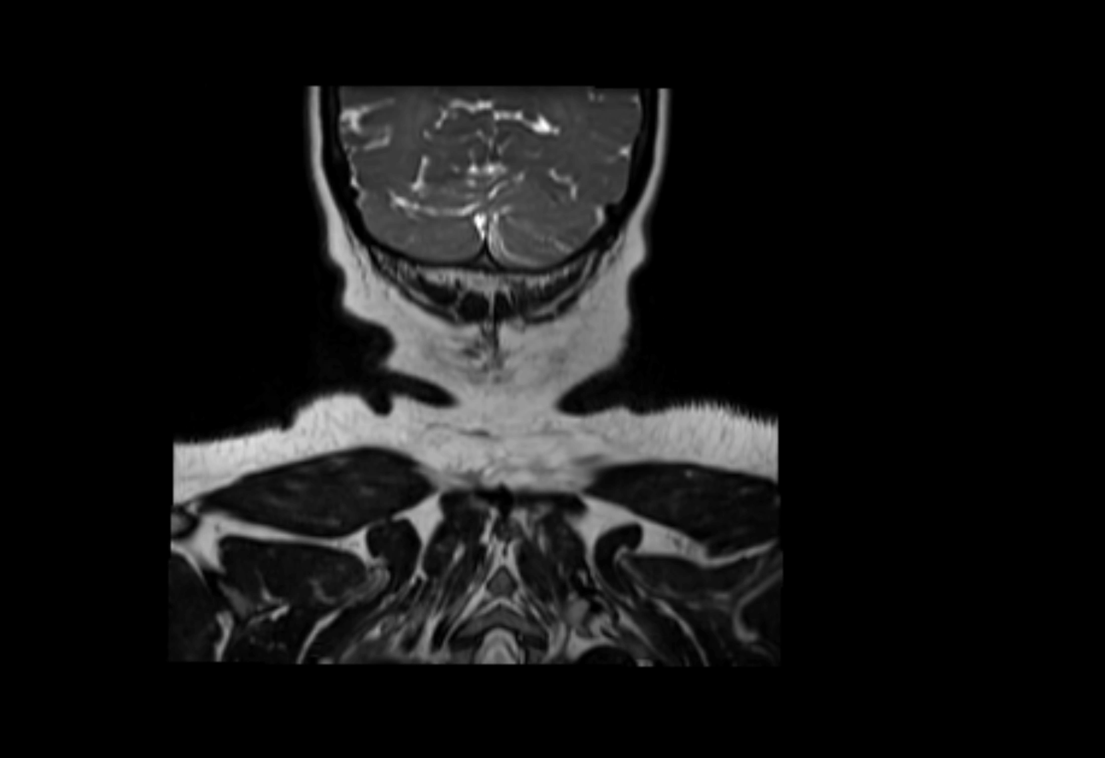 Neck coronal lymph node cross sectional MRI anatomy 3T MRI  image-img-00001-00004.webp